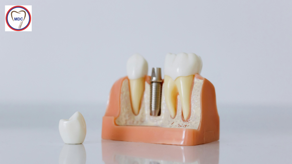 Dental Fillings