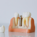Dental Fillings