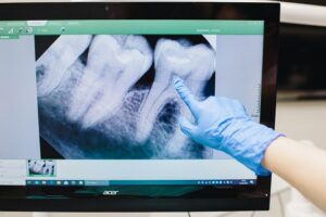 Intra-oral Scanner: Advanced Digital Dentistry Solution