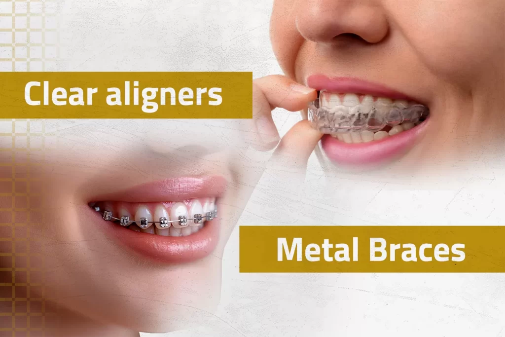 Braces & Aligners