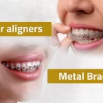 Braces & Aligners