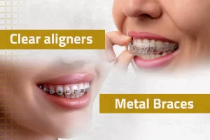 Braces & Aligners