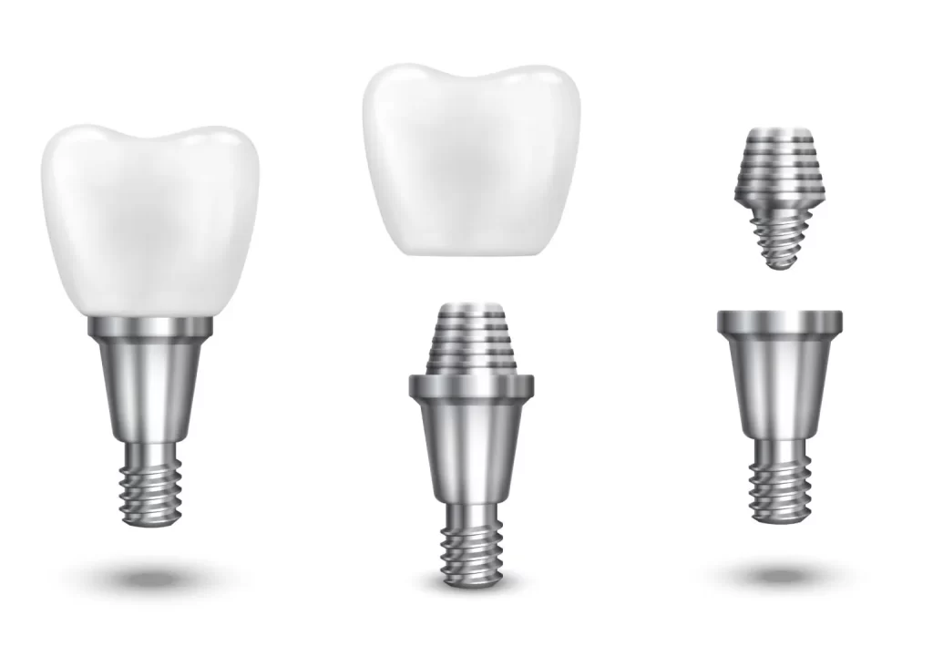 dental implant