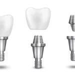dental implant