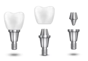 dental implant