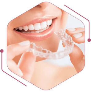 Dental Aligners