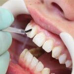 Cosmetic tooth-colored composite filling restoring a decayed tooth