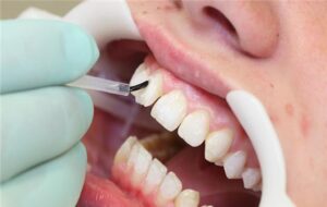 Cosmetic tooth-colored composite filling restoring a decayed tooth